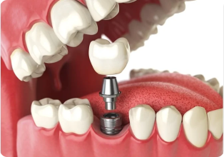Implants - Manam Dental Ghana